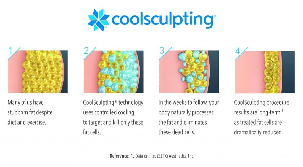 Coolsculpting before and after stomach