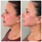 Improve your jawline with Juvederm Volux!