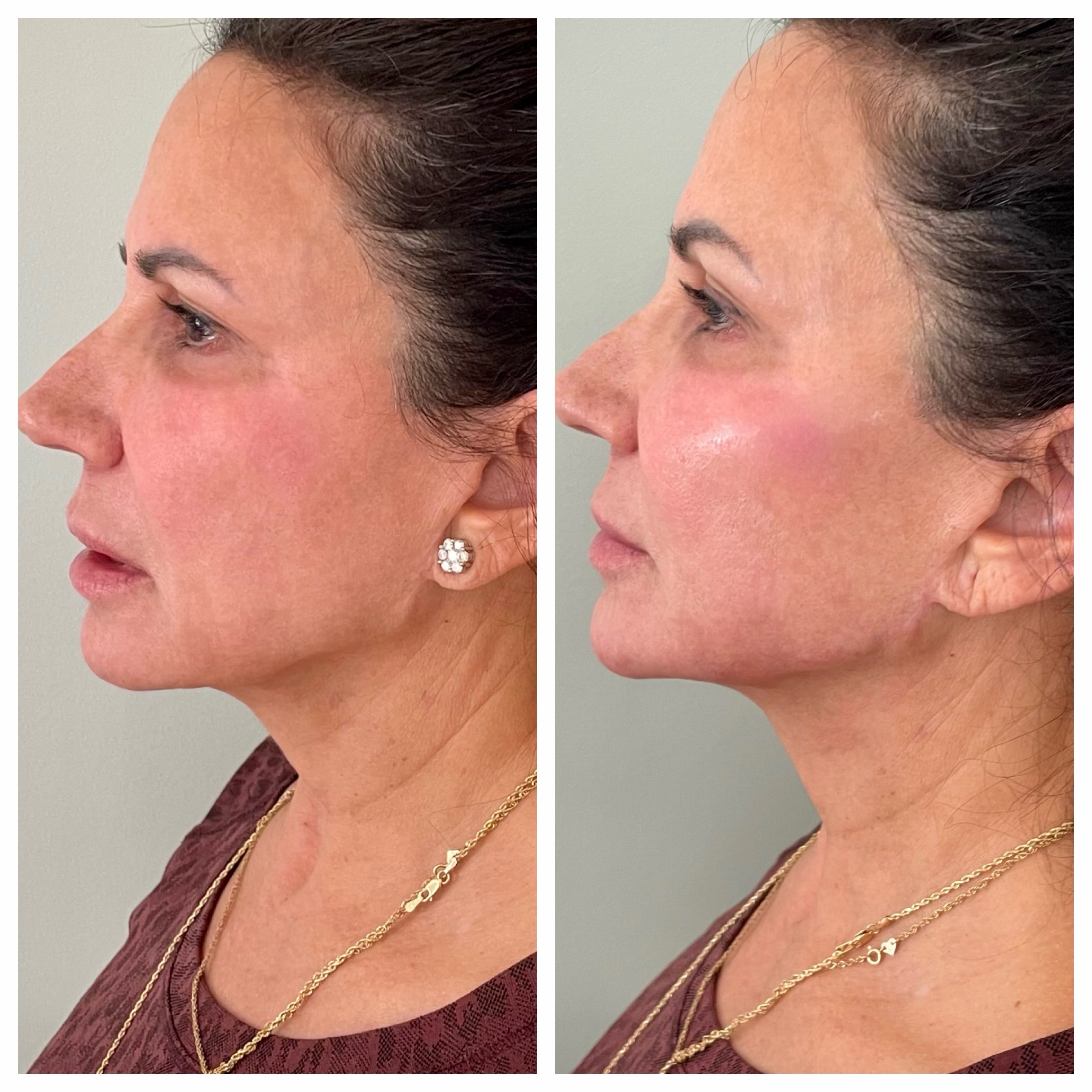 Thirty minutes with Refine, MD and some Juvederm® Volux TM can give your  jawline an amazing contour that can last…